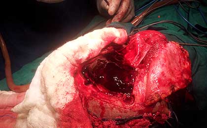 Subdural Haematoma