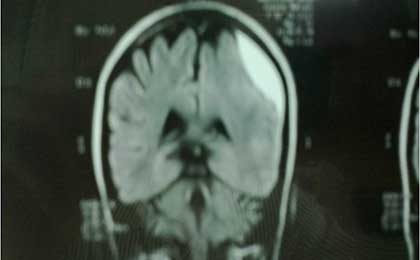 Subdural Haematoma