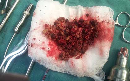 Subdural Haematoma