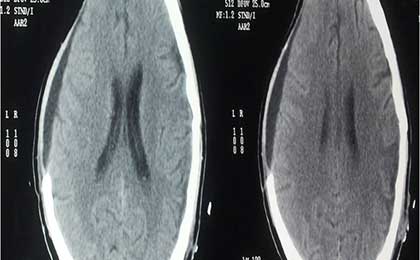 Subdural Haematoma
