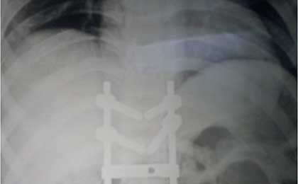 Traumatic Spine Injury