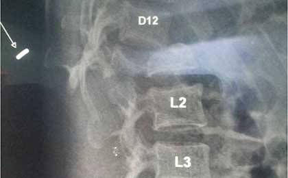 Traumatic Spine Injury