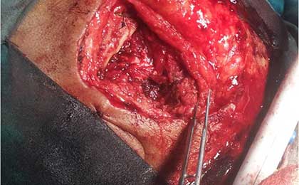 Trigeminal Neuralgia