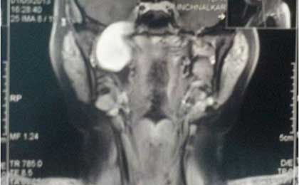 Trigeminal Neuralgia