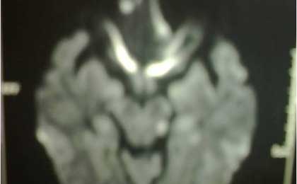 Trigeminal Neuralgia