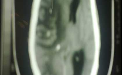 Venous Infarct Brain