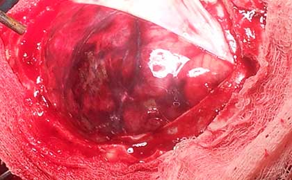 Venous Infarct Brain