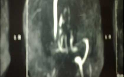 Venous Infarct Brain