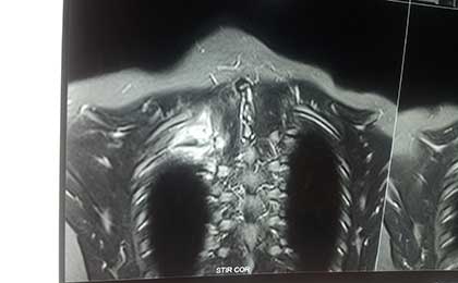 Vertebroplasty