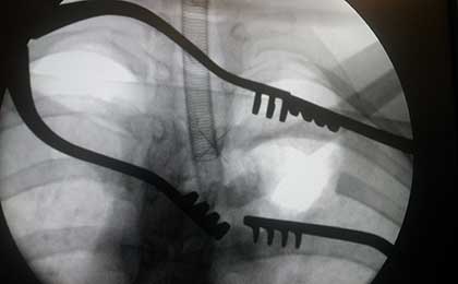 Vertebroplasty
