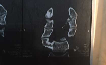 Vertebroplasty