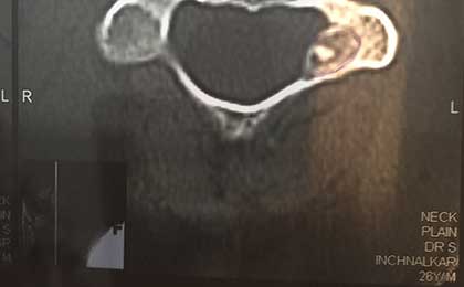 Vertebroplasty