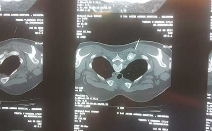 Vertebroplasty