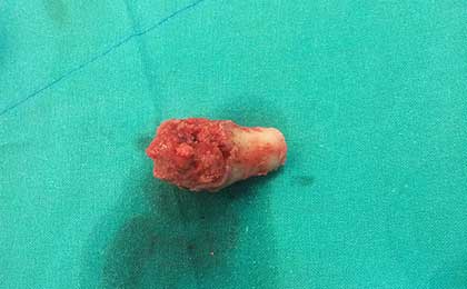 Vertebroplasty