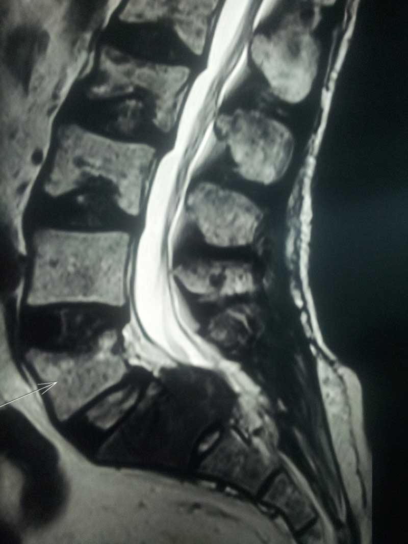 Vertebroplasty
